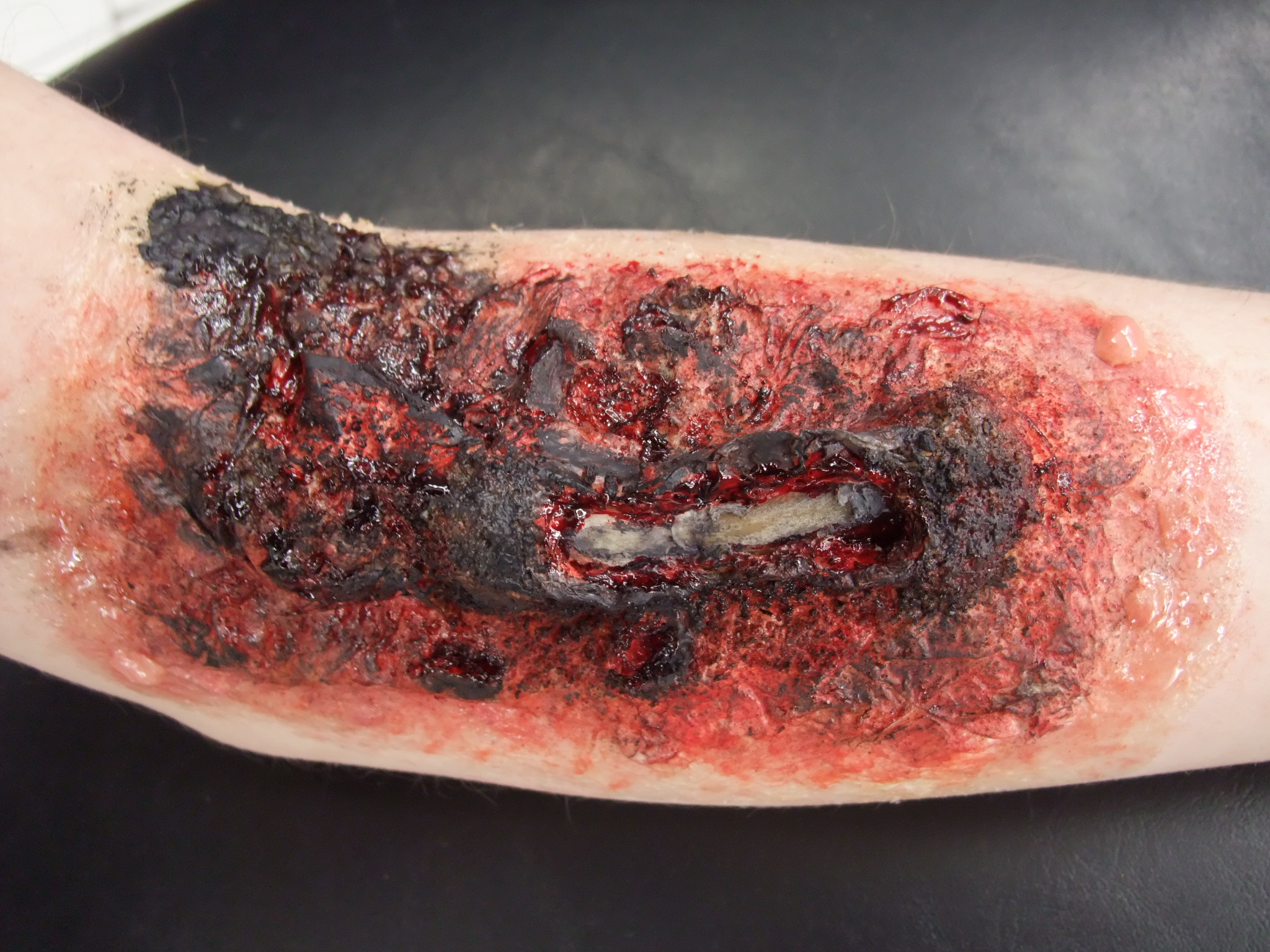 3rd Degree Burn Treatment Pictures, Images & Photos ...